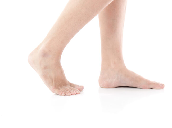 Two flat feet in walking position